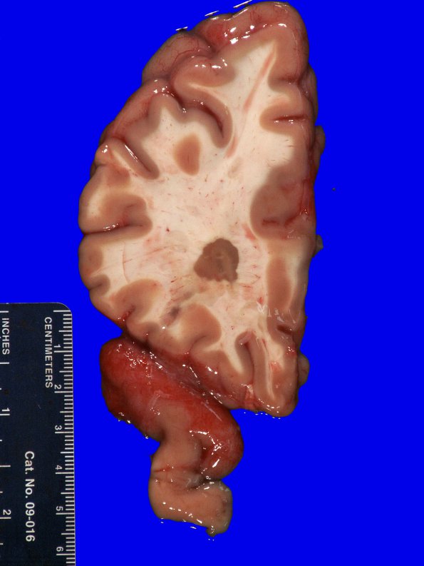 11B3 Multiple Sclerosis (Case 11) 6A