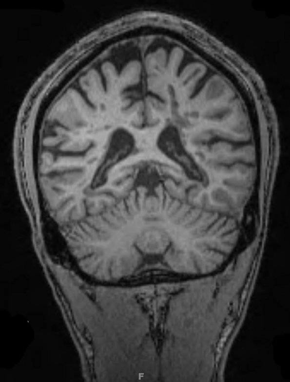 13A3 MS (Case 13)  MRI 14 T1 MPRAGE 3 - Copy