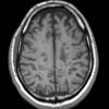 13A4 MS (Case 13) T1 without contrast1-11-2011 2 - Copy