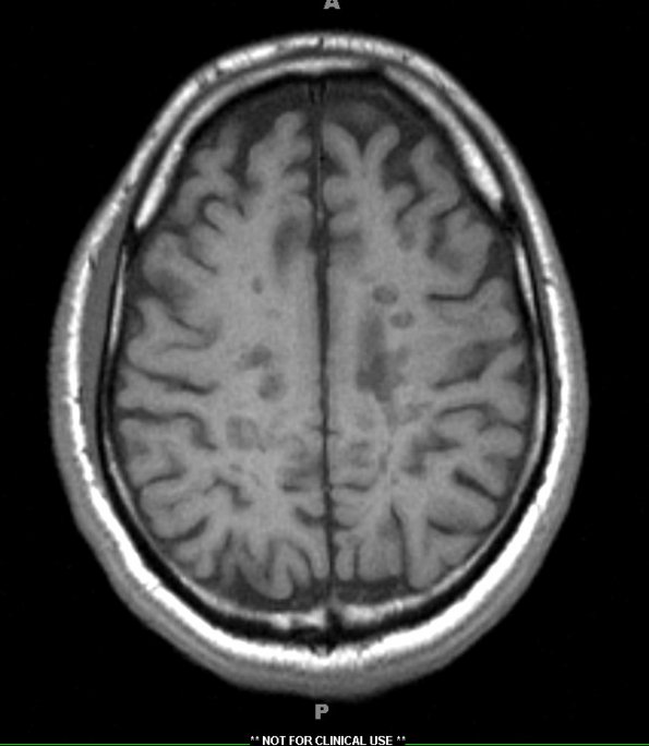 13A4 MS (Case 13) T1 without contrast1-11-2011 2 - Copy