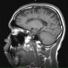 13A5 MS (Case 13) T1 without contrast1-11-2011 - Copy