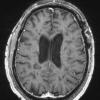 13A6 MS (Case 13) T1 with contrast 7-26-2011 4 - Copy