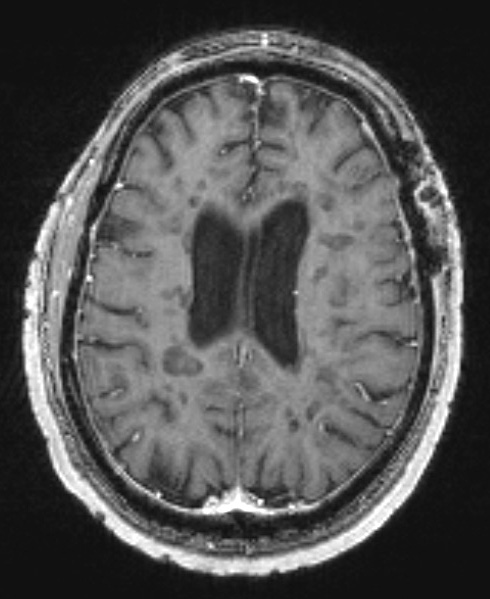 13A6 MS (Case 13) T1 with contrast 7-26-2011 4 - Copy