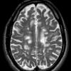 13A7 MS (Case 13) T2 with contrast1-11-2011 2 - Copy