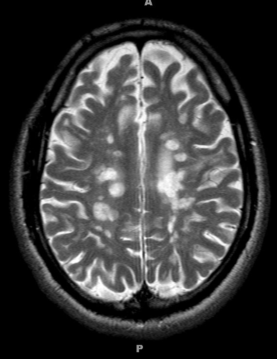 13A7 MS (Case 13) T2 with contrast1-11-2011 2 - Copy