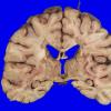 13B1 Multiple Sclerosis (Case 13) MRI _4A