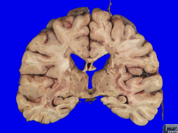 13B1 Multiple Sclerosis (Case 13) MRI _4A