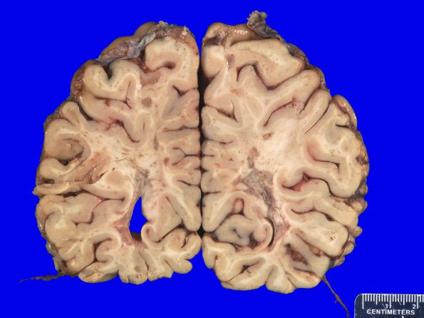 13B2 Multiple Sclerosis (Case 13) MRI _5A