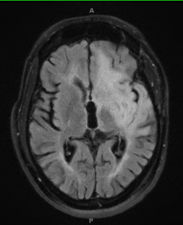 13C1 MS (Case 13) FLAIR tumor 2013 - Copy