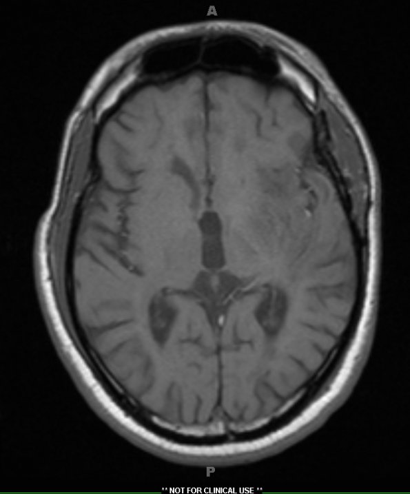 13C2 MS (Case 13) T1 no contrast tumor 2013 - Copy