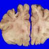 13D1 Multiple Sclerosis (A14-7) MRI _1A