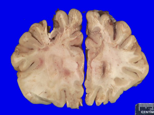 13D1 Multiple Sclerosis (A14-7) MRI _1A