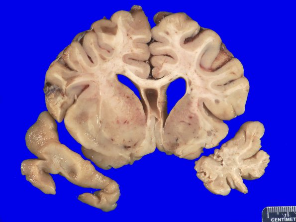 13D2 Multiple Sclerosis (A14-7) MRI _2A