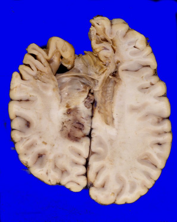 14A2 MS & Radiation for Glioma (Case 14A) 2A