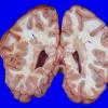 14B Multiple Sclerosis (Case 14B) 1 copyA