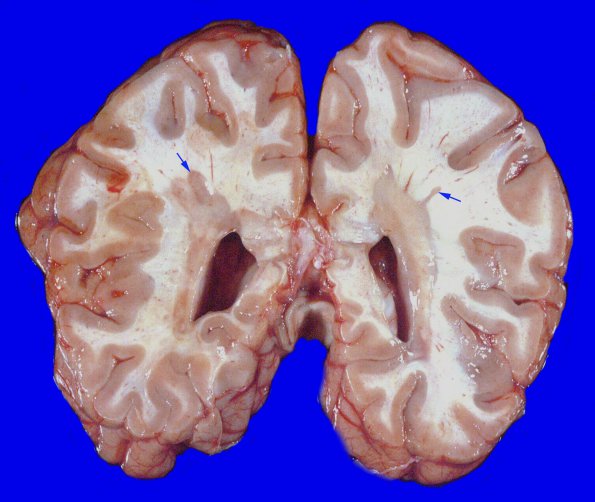 14B Multiple Sclerosis (Case 14B) 1 copyA