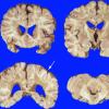 14D Multiple Sclerosis (Case 14D) gross 2 copy