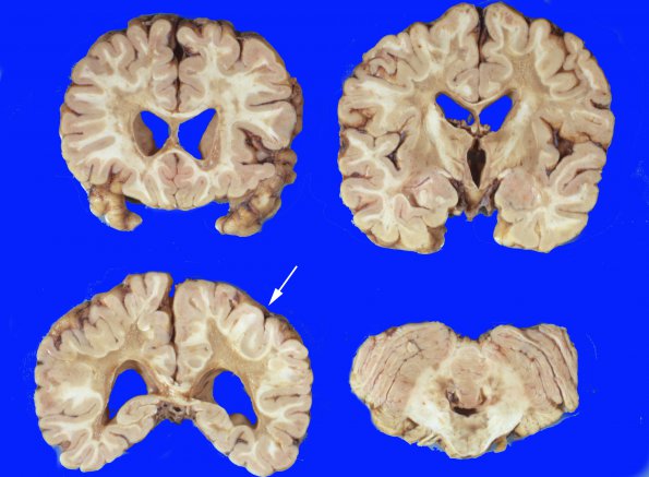 14D Multiple Sclerosis (Case 14D) gross 2 copy