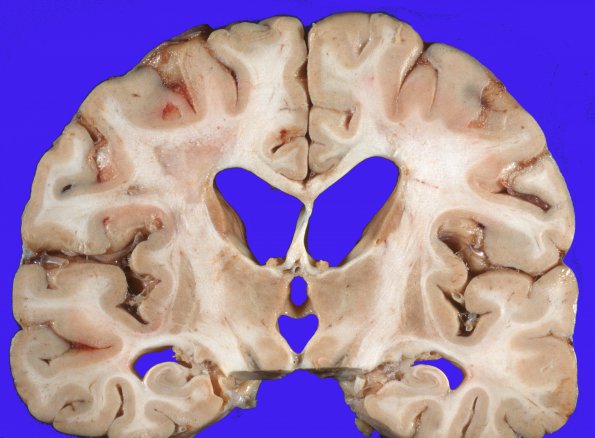 14E1 MS (WU Case) Gross 1