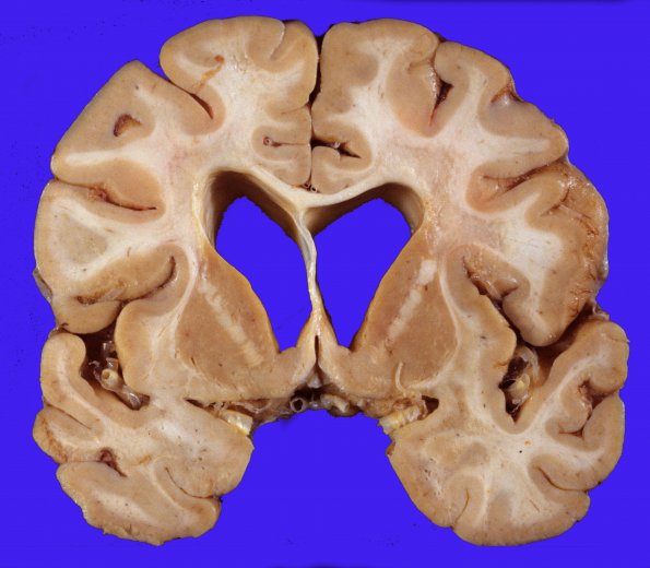 14E3 MS (WU Case) Gross 3