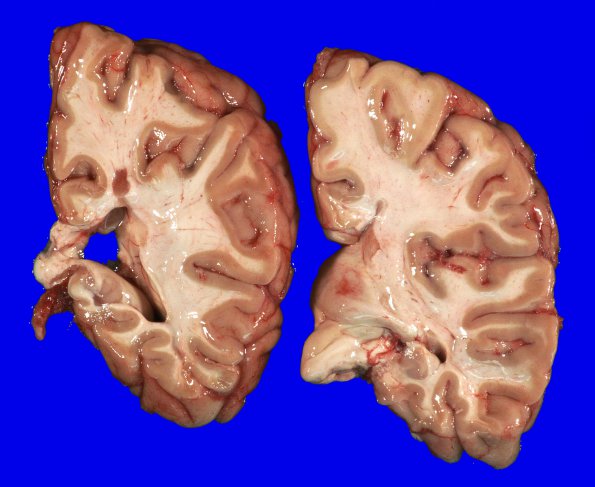 14G1 Multiple Sclerosis, 50 yr Hx (Case 14G) 15A