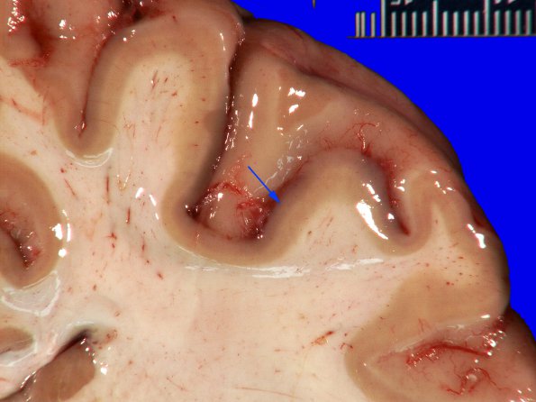 14G2 Multiple Sclerosis, 50 yr Hx (Case 14G) 13 copyA