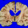 14I1 Multiple Sclerosis (Case 14I) 3A