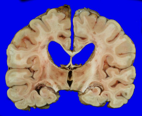 14I1 Multiple Sclerosis (Case 14I) 3A