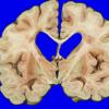 14I2 Multiple Sclerosis (Case 14I) 8A