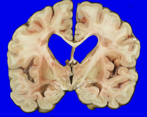 14I2 Multiple Sclerosis (Case 14I) 8A