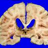 14I3 Multiple Sclerosis (Case 14I) 10A