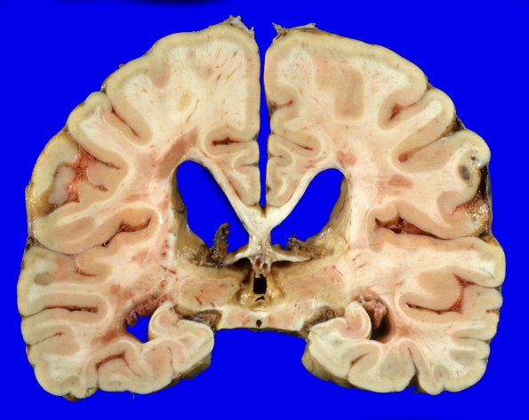 14I3 Multiple Sclerosis (Case 14I) 10A