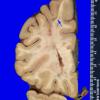 14K Multiple Sclerosis (Case 14K) 1 copyA