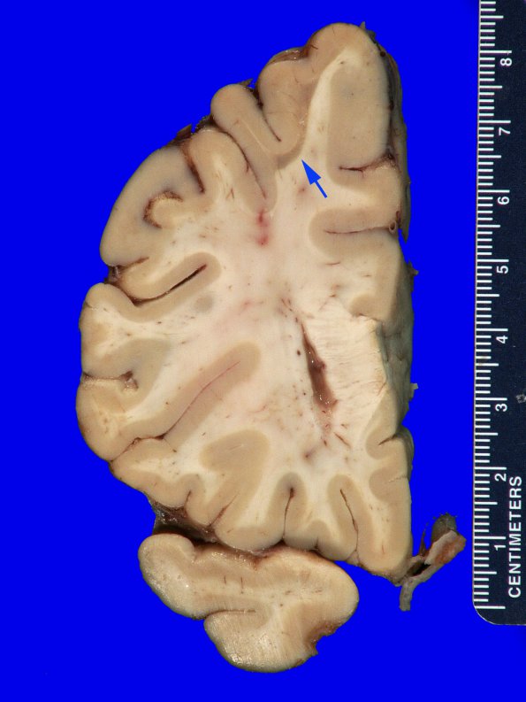 14K Multiple Sclerosis (Case 14K) 1 copyA