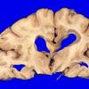 14L1 Multiple Sclerosis (Case 14L) 1A