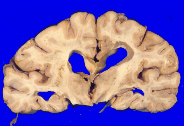 14L1 Multiple Sclerosis (Case 14L) 1A