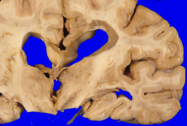 14L2 Multiple Sclerosis (Case 14L) 2A