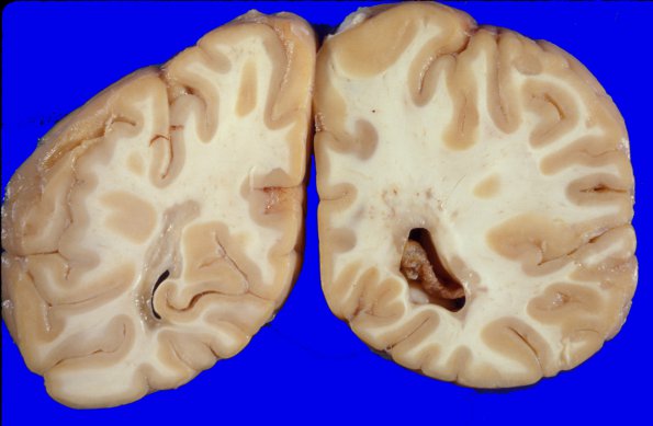 1A1 MS, Cortical Plaque (Case 1) 22A