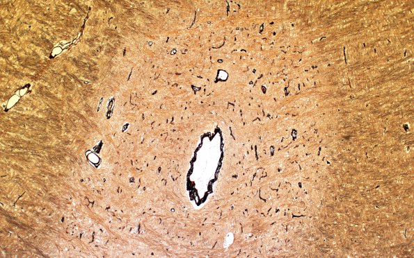 1B3 RRMS Plaque (Case 1) Bielschowsky 4X