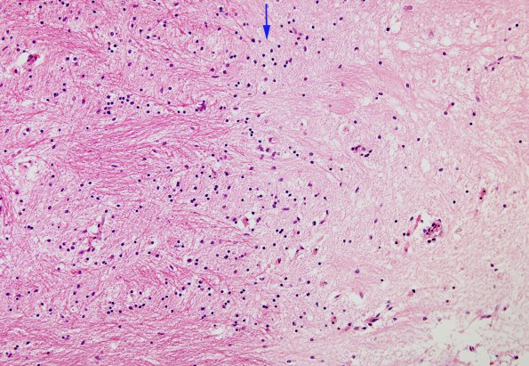 1B4 MS, Plaque (Case 1) H&E 20X copy