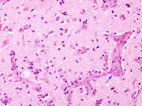 1C1 Infarct (Case 1A) compare with MS H&E 40X copy