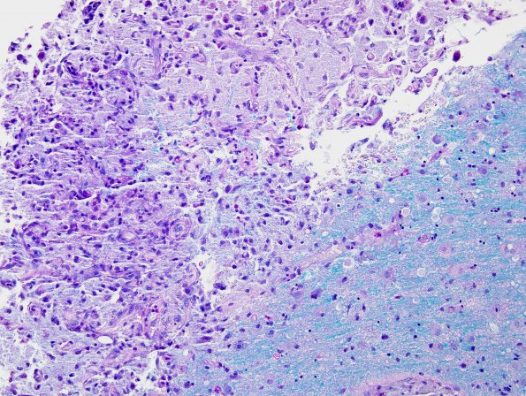 1C2 Infarct (Case 1A) compare with MS LFB-PAS 20X