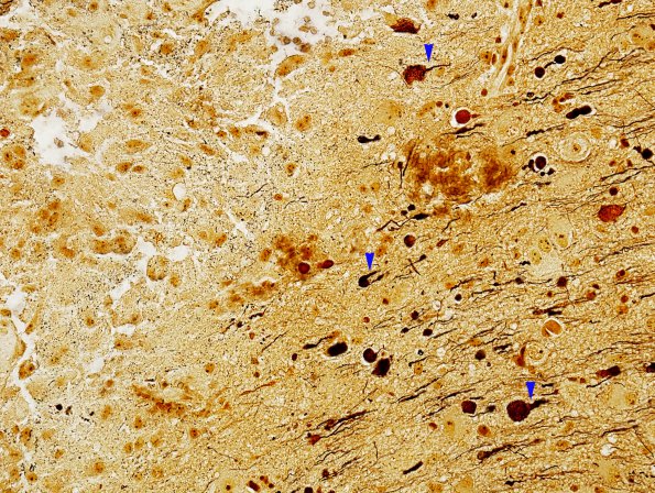 1C3 Infarct (Case 1A) compare with MS Biels 40X 1 copy