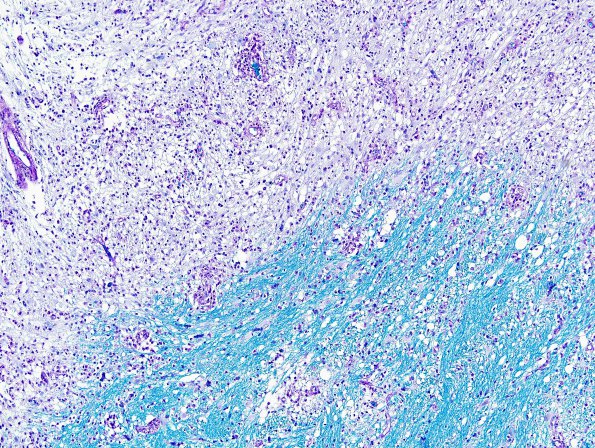 1D1 Multiple Sclerosis, Active edge (Case 1B) LFB-PAS 1