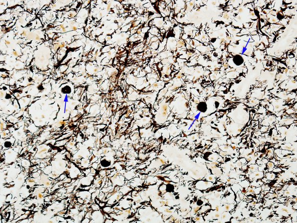 1D2 Multiple sclerosis, Acute (Case 1C) Biels 40X copy