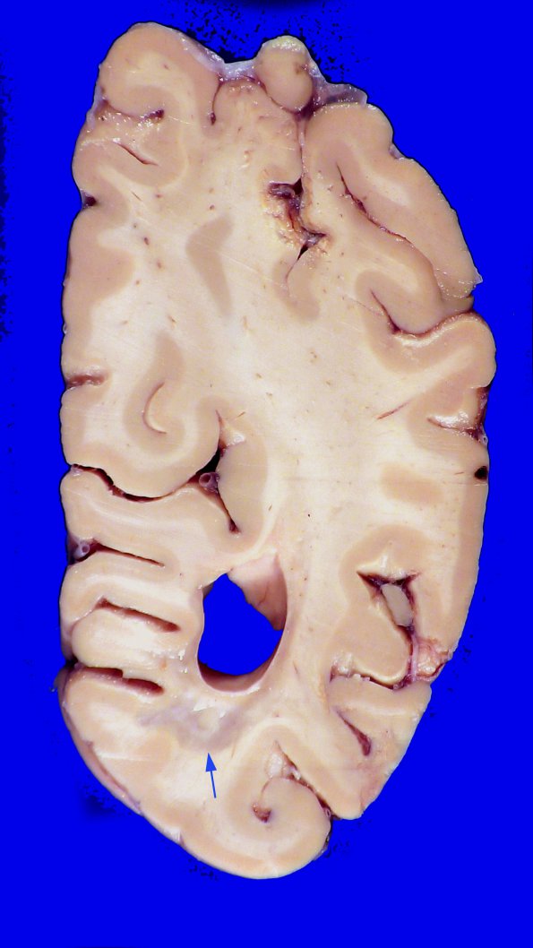 2A1 MS (Case 2) Gross 1 copyA