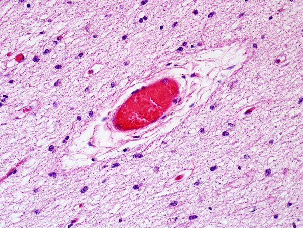 2C1 MS, inactive (Case 2) H&E 40X