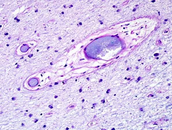 2C2 MS, inactive (Case 2) LFB-PAS 40X