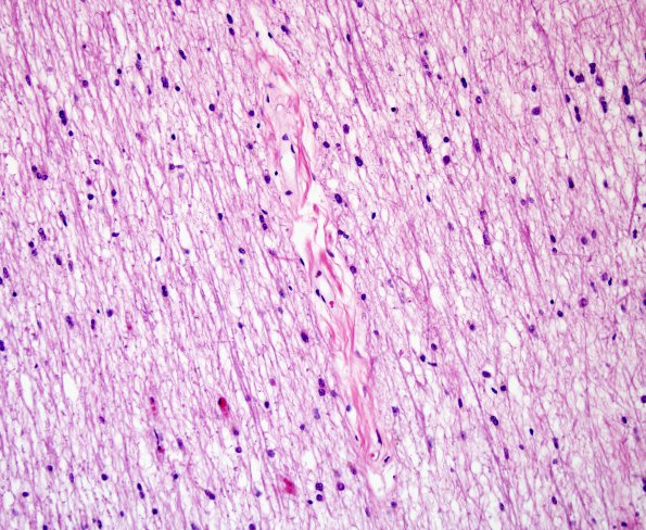 2D MS (Case 2) N5 H&E 1