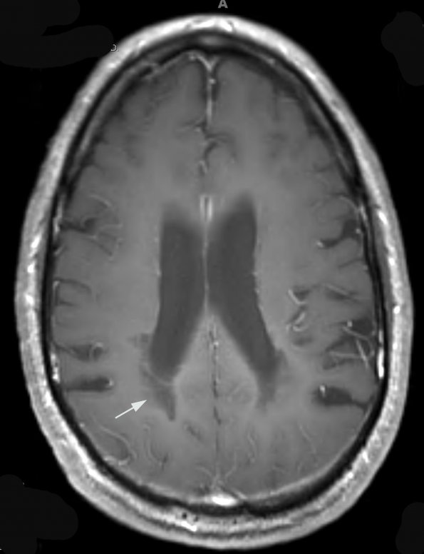 3A2 MS (Case 3) T1 Post-Contrast 3 copy - Copy